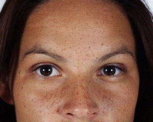 freckled-face-1251424